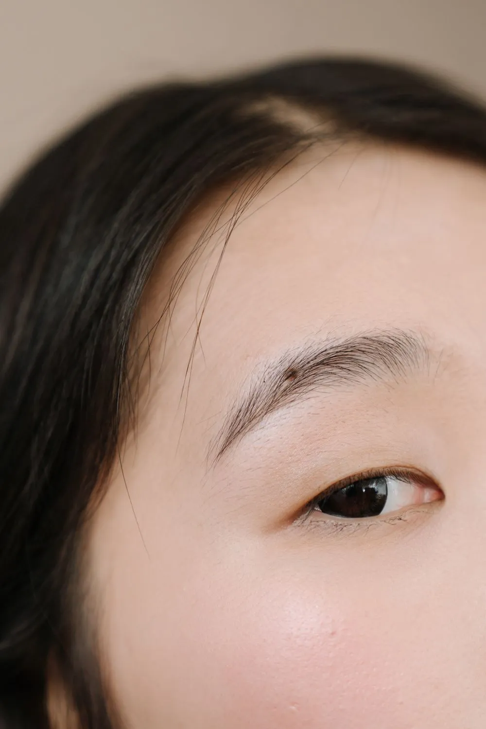 Acne and pigmentation program result
